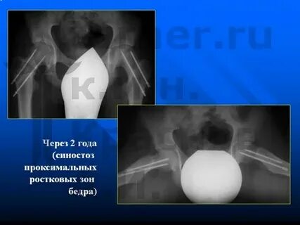 Эпифизеолиз код мкб
