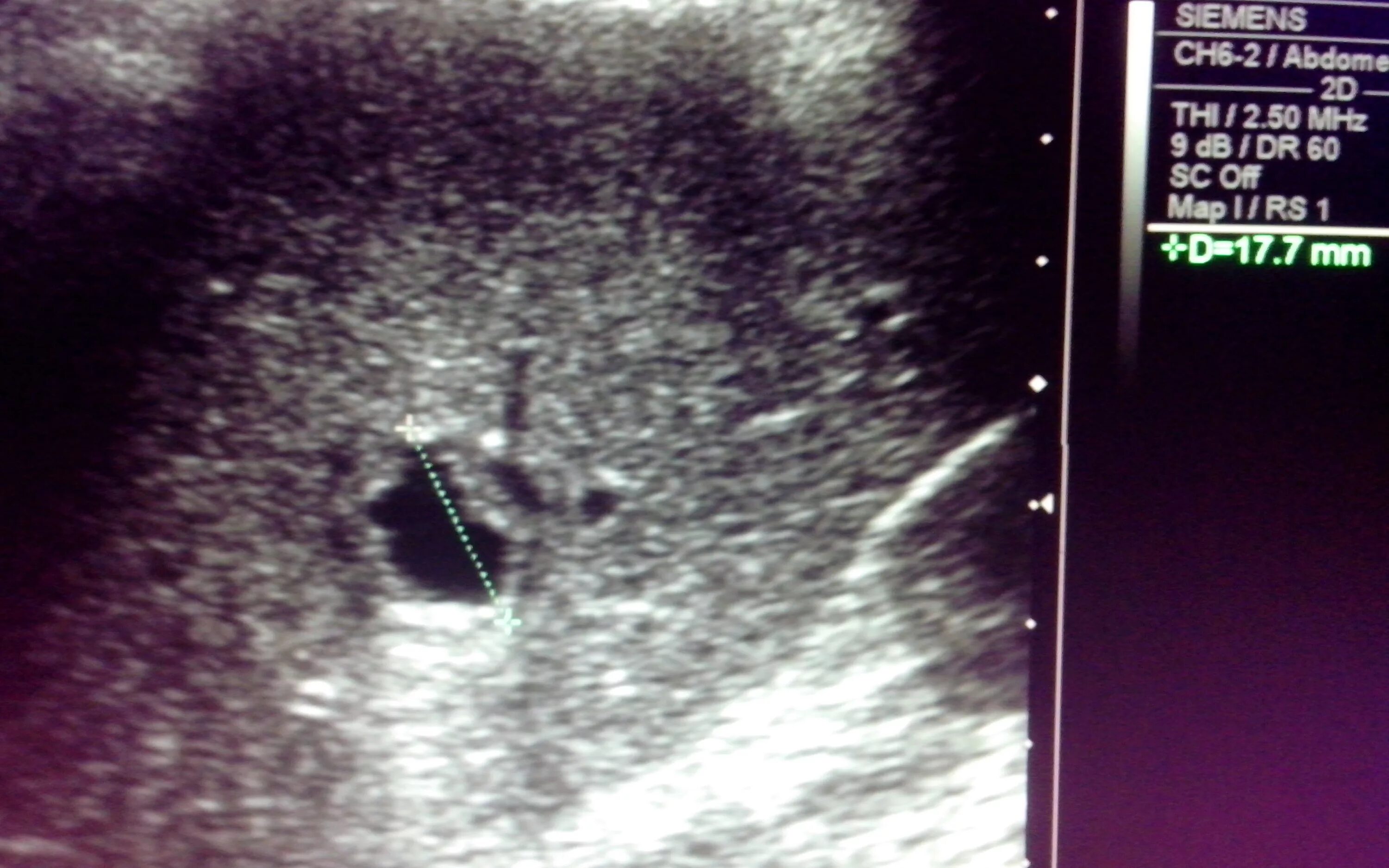 видно ли глистов на узи