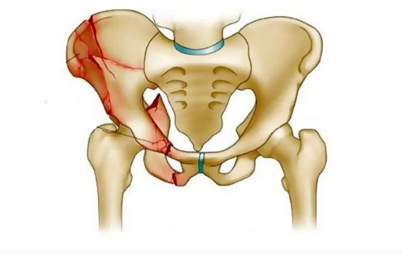 Перелом таза и тазобедренной кости. Лонная кость таза перелом. Лонная кость тазобедренного сустава. Подвздошная кость таза перелом. Болит тазовая кость справа