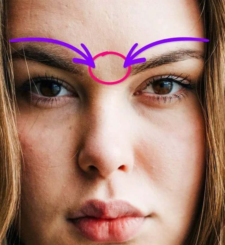 Контагиозный моллюск сыпь. Контагиозный моллюск сыпь. Высыпания на лице зоны. Лоб. Высыпания на лице зоны.