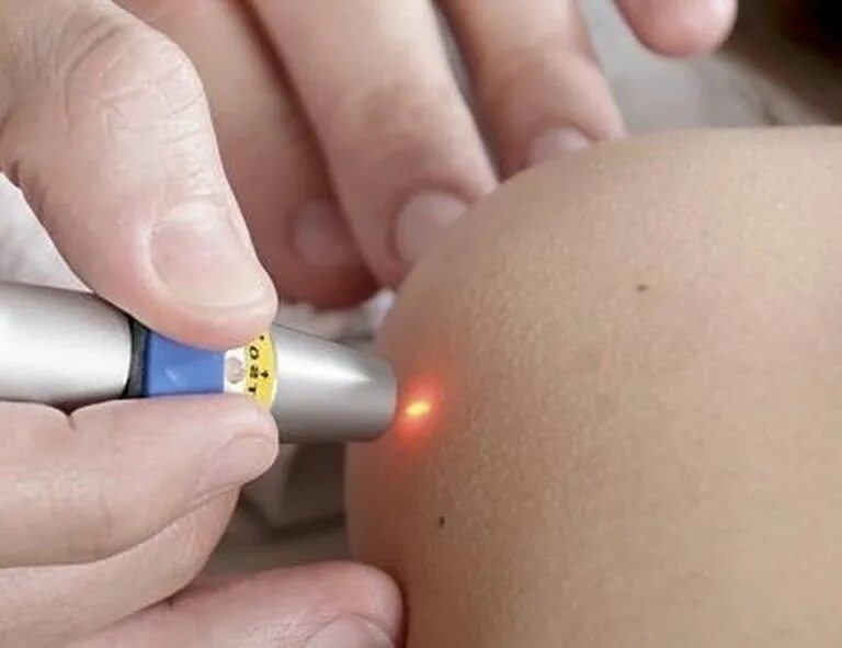 Принципы криодеструкции. Выжигание бородавок азотом. Пузырь после прижигания жидким азотом. Выжигать азотом. Криодеструкция новообразований кожи.