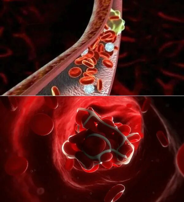 Профилактика тромбозов артерий. Профилактика лечения тромбов
