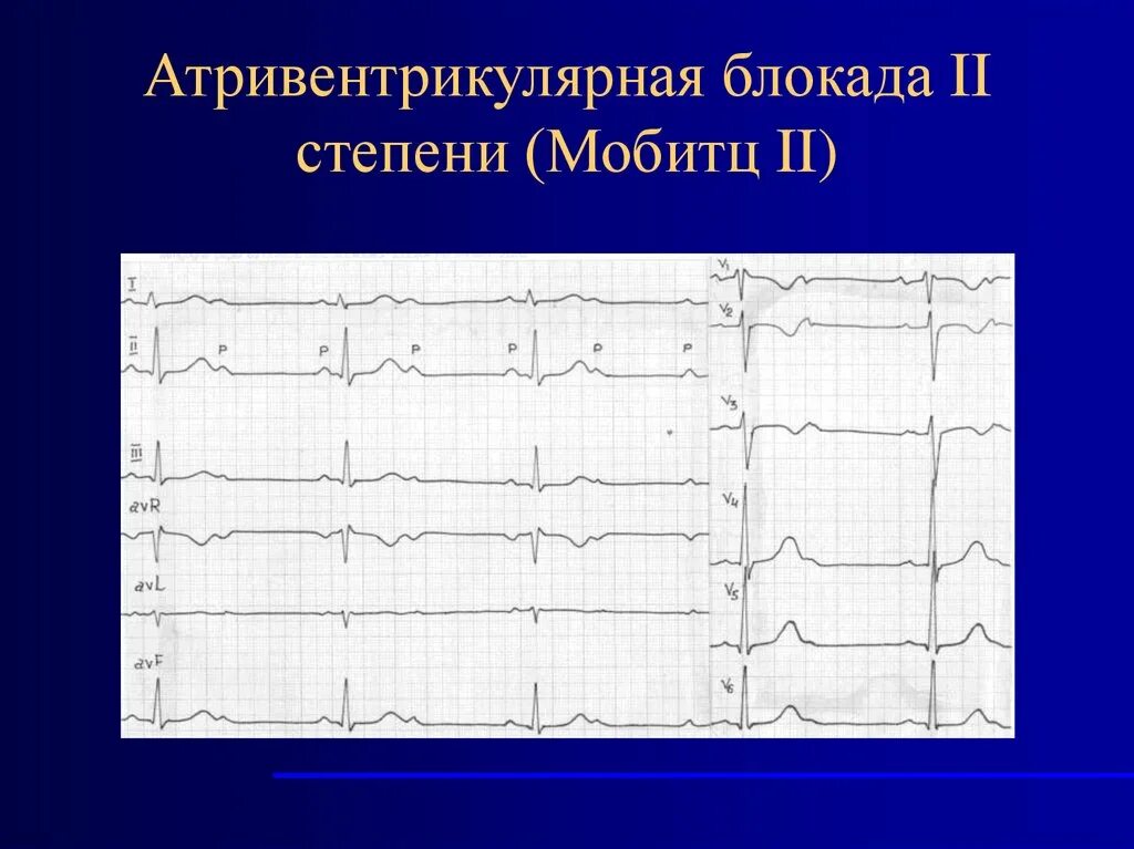 Атриовентрикулярная блокада 2. АВ блокада 2 степени Мобитц 1 на ЭКГ. Атриовентрикулярная блокада 2 степени Мобитц 2 на ЭКГ. АВ блокада 2 степени Мобитц 3 на ЭКГ. Атриовентрикулярная блокада Мобитц 1.