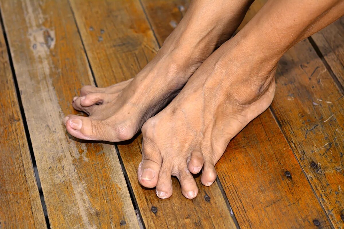Пальцы на ногах картинки. Ревматоидный артрит стопы.