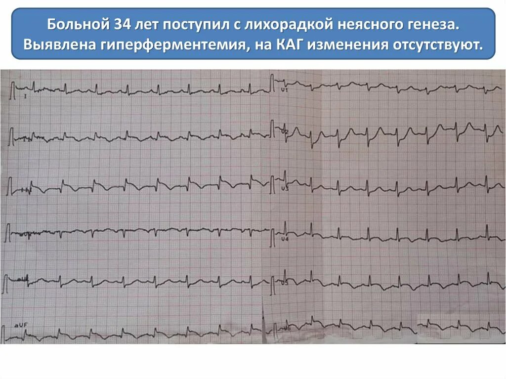 Элевация сегмента st. Элевация сегмента st на холтере. эпизоды элевации сегмента st на холтере. гиперферментемия неясного генеза. дифференциальная диагностика подъема сегмента st на экг.