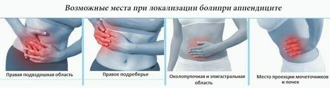 Аппендицит сколько в больнице. Где находится аппендицит фото. расположение болей при аппендиците.