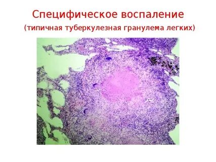 Специфический туберкулезный процесс