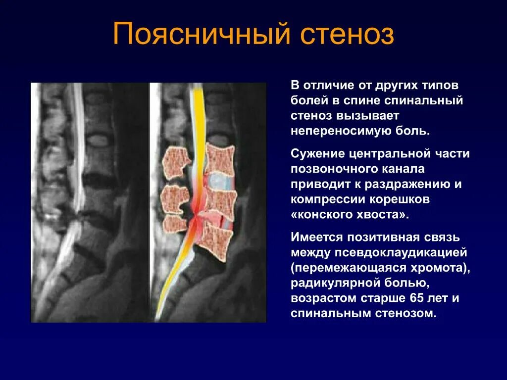 Стеноз позвоночного канала l2-l4. Компрессия s1 корешка позвоночника.. Диагноз спинальный стеноз поясничного отдела. Сужение спинального канала позвоночника. Крестцовый стеноз