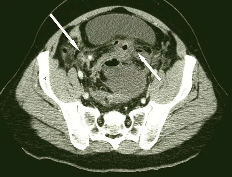 Камни на кт видны. Интраабдоминальный абсцесс кт. Межкишечный абсцесс на кт. Периаппендикулярный абсцесс кт.