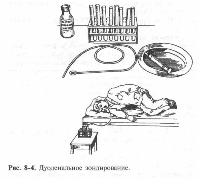Выполнение дуоденального зондирования