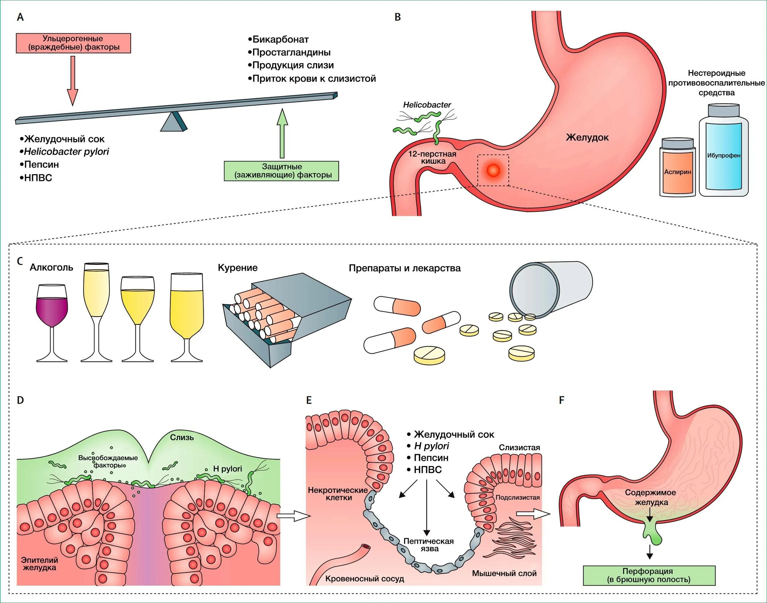 Возникновение язвы желудка. Фактори риска перфорация язва желудка. Перфорация язвы желудка этиология. Этиология язвенной болезни ДПК. Язвенная болезнь желудка и 12 перстной кишки причины.