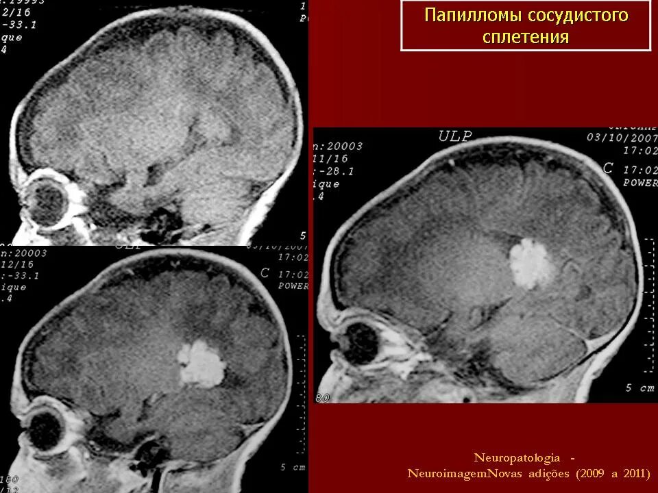 Папилломы сосудистого сплетения кт. Опухоли сосудистого сплетения. Киста сосудистого сплетения кт. Папиллома хориоидного сплетения кт.
