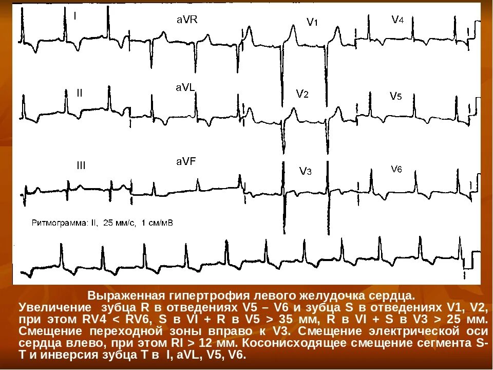 Гипертрофия миокарда лж что это. ЭКГ гипертонической болезни гипертрофия левого желудочка. Гипертрофия миокарда левого желудочка препарат. Гипертрофия левого желудочка сердца на ЭКГ.