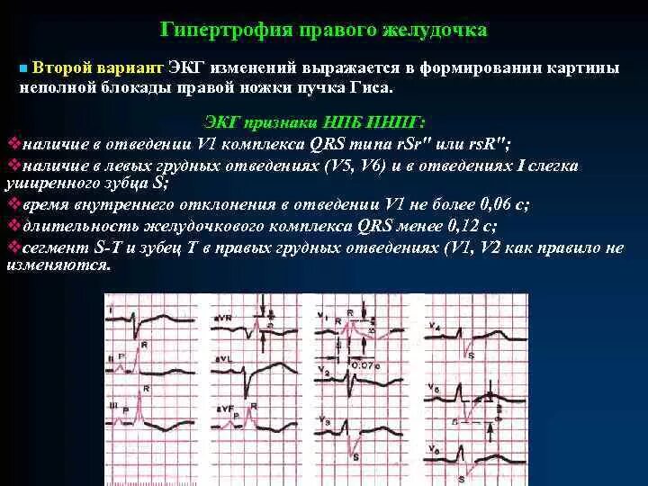 ЭКГ признаки гипертрофии правого желудочка на ЭКГ. Признаками s-типа гипертрофии правого желудочка. Блокада левой ножки пучка Гиса с гипертрофией на ЭКГ. Правожелудочковая гипертрофия ЭКГ. Очаговые изменения желудочка