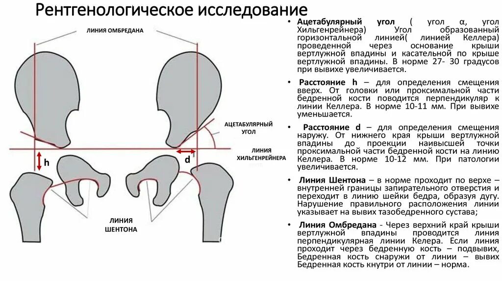 Бедренный угол