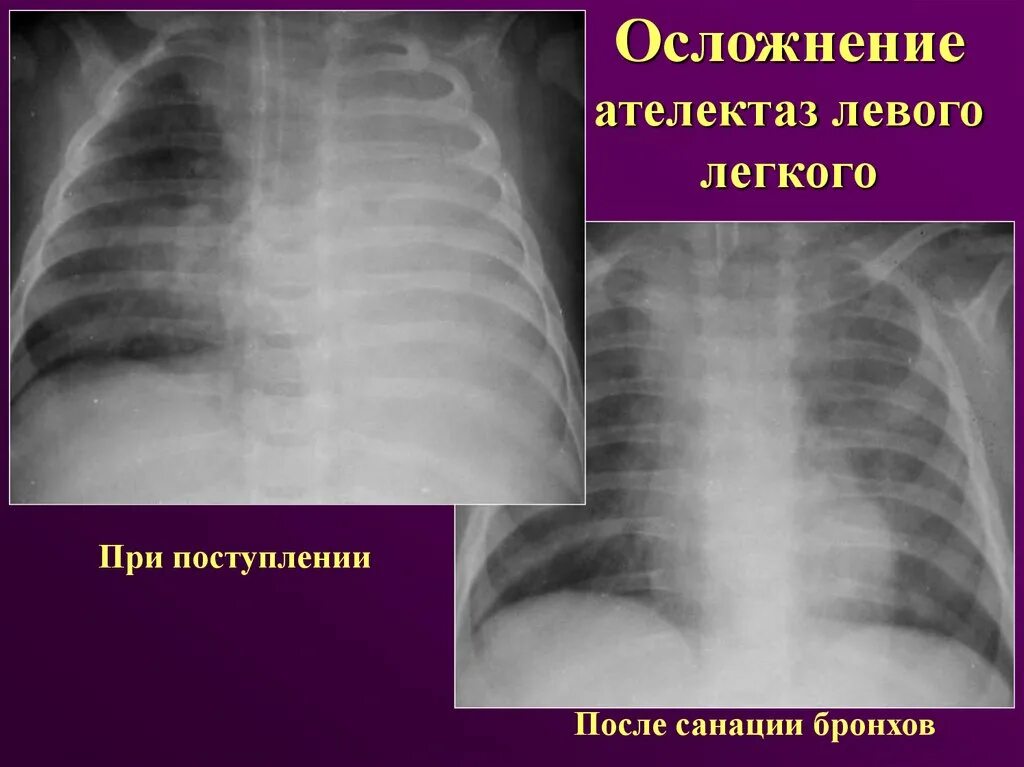 Сегментарный ателектаз рентген. Компрессионный ателектаз легкого. Пневмоторакс ателектаз легкого. Ателектаз лёгкого рентген. Обтурационный ателектаз легкого