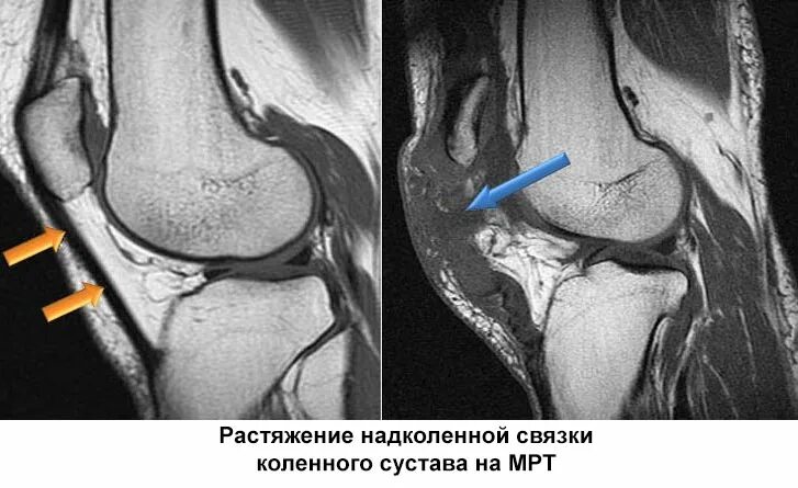 Повреждение сухожилие надколенника. Частичный разрыв надколенника. Повреждение связки надколенника симптомы. Частичный разрыв надколенника. Повреждение связки надколенника мрт.