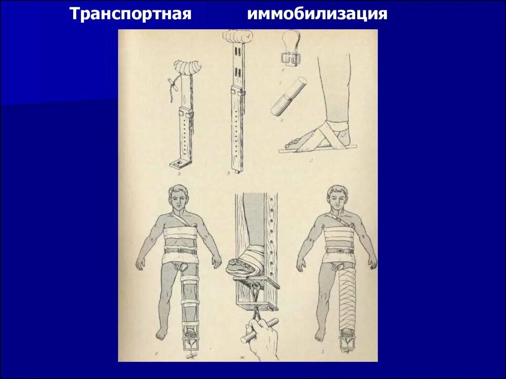 Как выполняется иммобилизация травмированной. Транспортная иммобилизация. транспортная и лечебная иммобилизация. транспортная иммобилизация при ожогах. травмы опорно-двигательного аппарата иммобилизация.