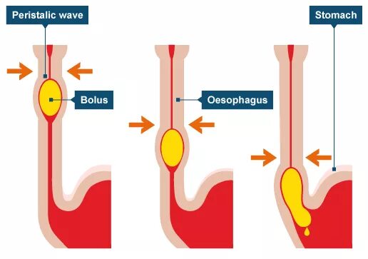 Прохождение пищи по пищеводу. Застряла пища в пищеводе. Комок в пищеводе