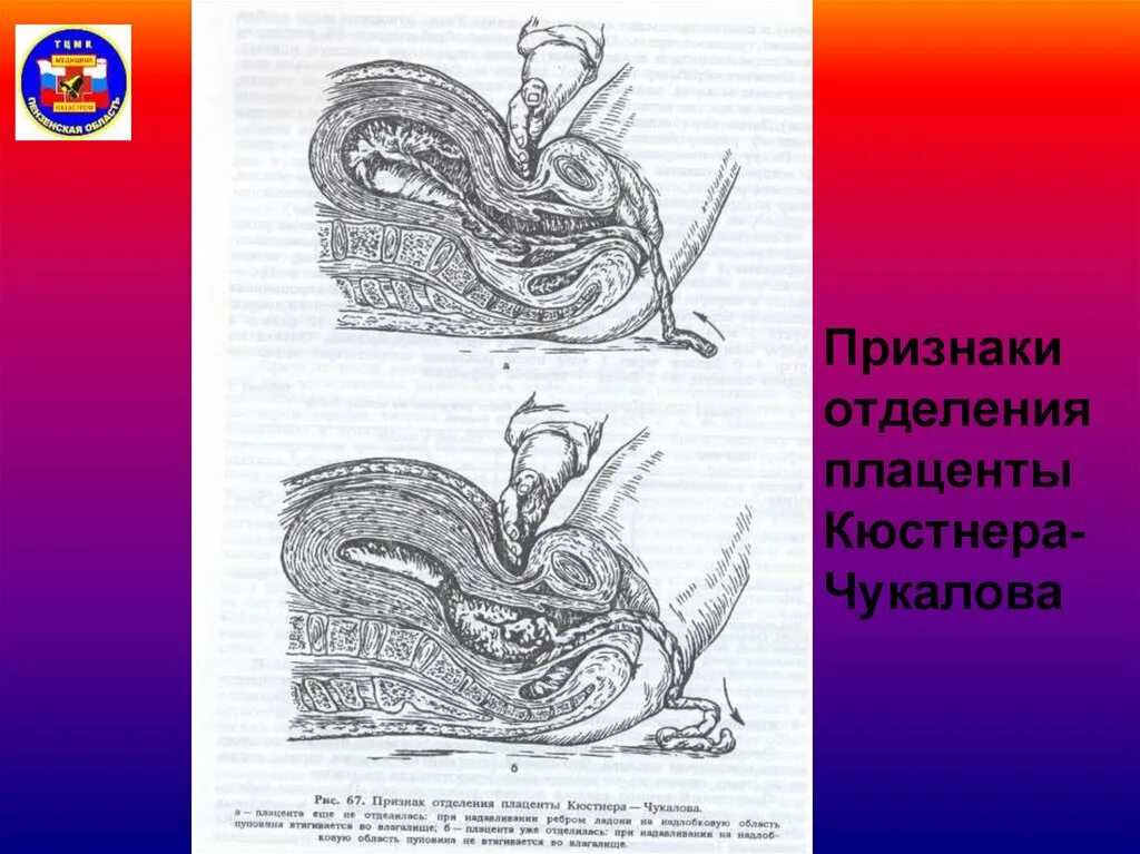 Признаки отделения плаценты кюстнера-чукалова. Признаки отделения плаценты кюстнера-чукалова. Признак отделения плаценты кюстнера чукалова. Признаки отделения плаценты кюстнера-чукалова. Признак кюстнера чукалова.