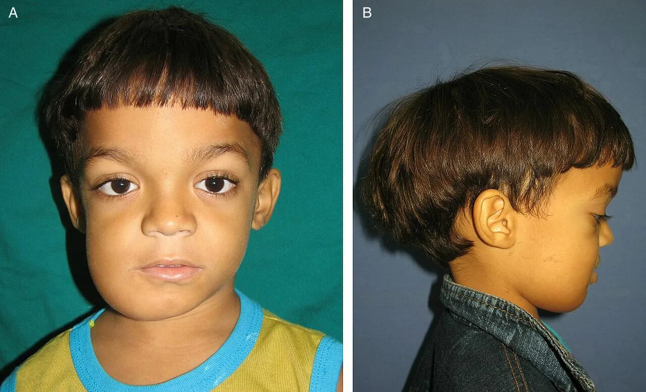 остеопороз костей рентген. форма костей патологических. ахондроплазия генная заболевание.