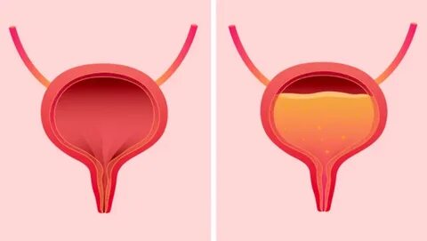 Understanding Urinary Retention: Definition and Types 