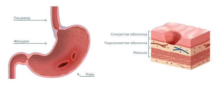 Салфетки язвы. Эрозия гастрит желудка. Изъязвление слизистой оболочки желудка.