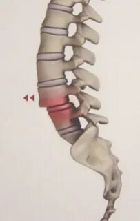 Антелистез l4
