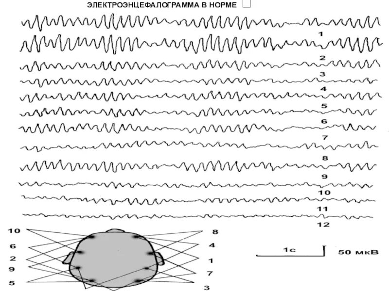 Ээг хабаровск. Альфа ритм на ЭЭГ норма. Сигнал ЭЭГ ЭЭГ сигнал. ЭЭГ показатели нормы. ЭЭГ головного мозга показатели.