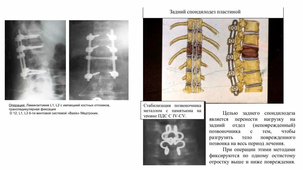 Компрессионный перелом тела т11 позвонка. Компрессионный перелом позвоночника тх12. Компрессионный перелом позвоночника т11 и т12 грудного отдела. Компрессионный перелом грудопоясничного отдела позвоночника.