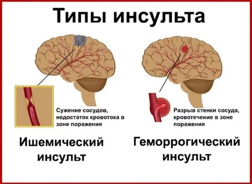 Причины сужения головного мозга. Инсульт. Виды инсульта. Исудьт.