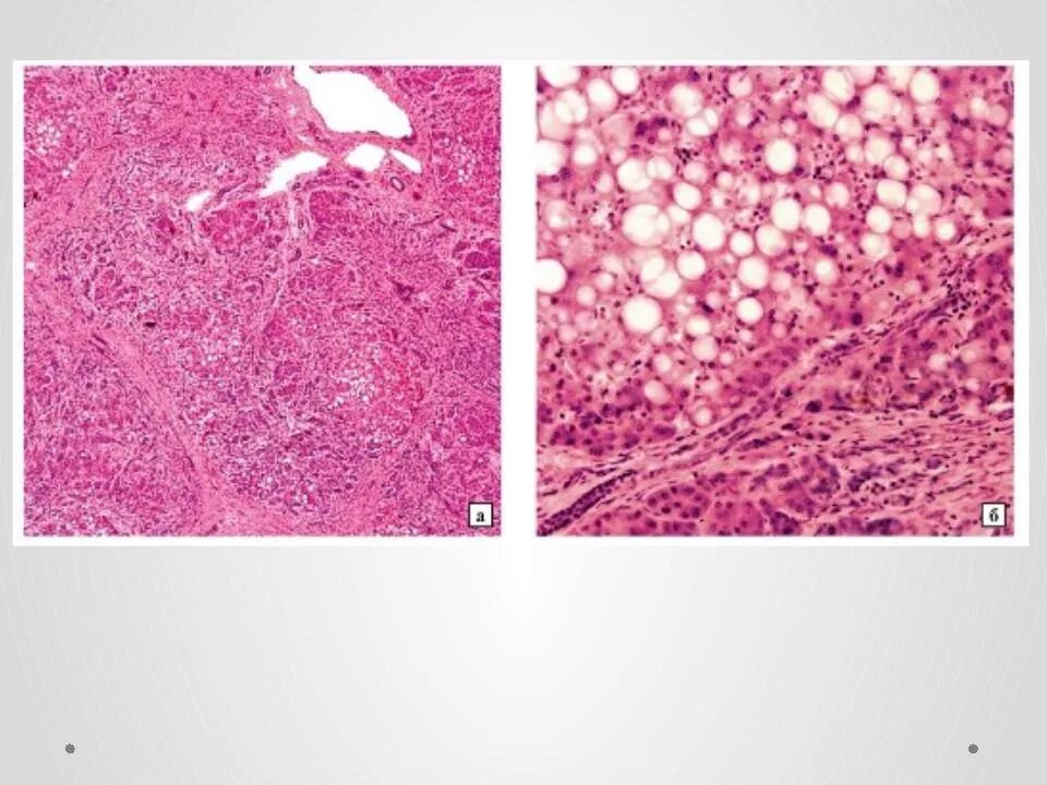 Мультилобулярный цирроз печени микропрепарат. Мелкоузловой цирроз печени микропрепарат. Мелкоузловой цирроз гистология. Билиарный цирроз печени гистология. Фиброзные изменения печени