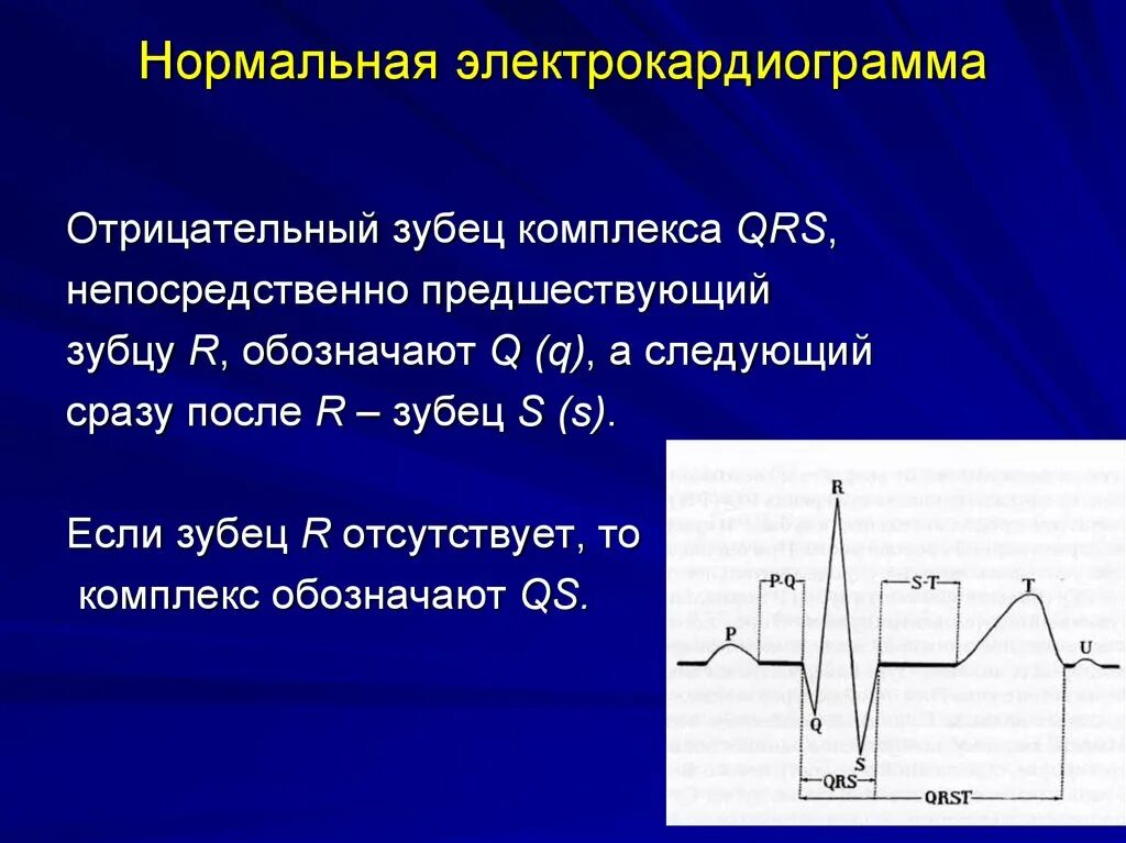 Qrs на экг что это. Отрицательный комплекс QRS на ЭКГ. Зубцы р наслаиваются на комплекс QRS. Отрицательный зубец р после QRS. Зубец р после QRS комплекса.