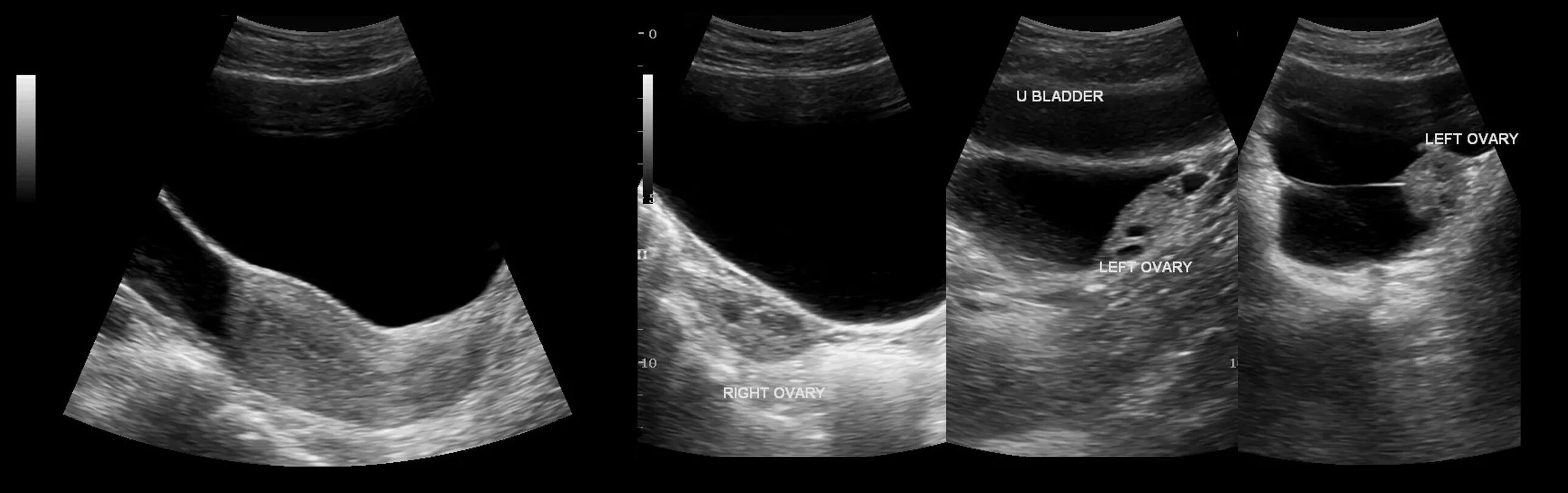 Датчик трансвагин узи. Серозоцеле в малом тазу. Мультилокулярная киста. Киста яичника на компьютерной томографии. Внутривагинальное узи.