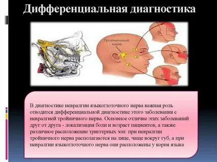 Невралгия языкоглоточного нерва лечение
