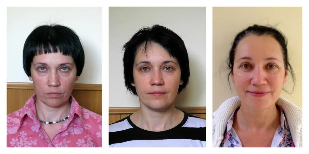 ревитоника овал лица. ревитоника до и после. ревитоника до и после фото. валики для лица. ревитоника носогубные складки упражнения.