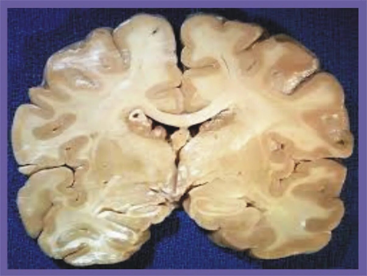 Атрофия мозга лечение. Атрофия головного мозга патанатомия. Туберозный рассеянный склероз. Гидроцефалия головного мозга макропрепарат. Макропрепарат туберозный глиоз.