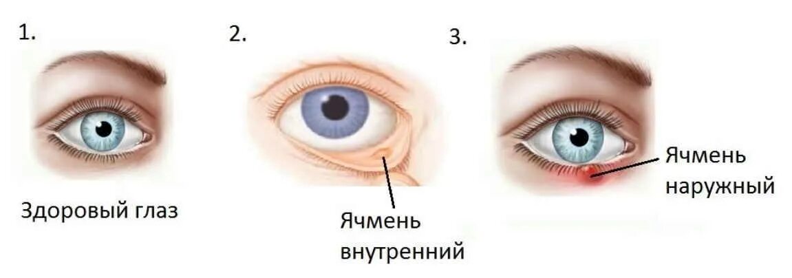 Можно с ячменем ходить в школу