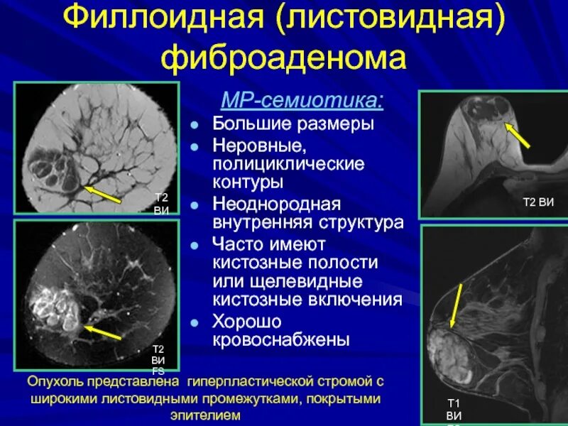 Филлоидная фиброаденома. Филлоидная опухоль молочной железы. Листовидная фиброаденома.