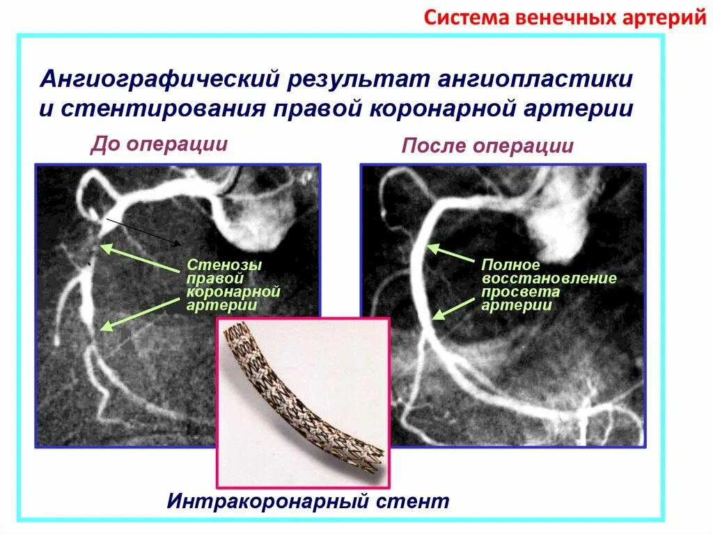 Стентирование сосудов последствия. Стентирование коронарных артерий. Стенты для коронарных сосудов. Стентирование венечных артерий.