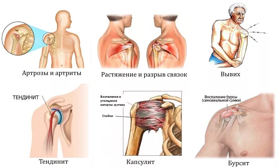 Сильная боль в плечевом суставе