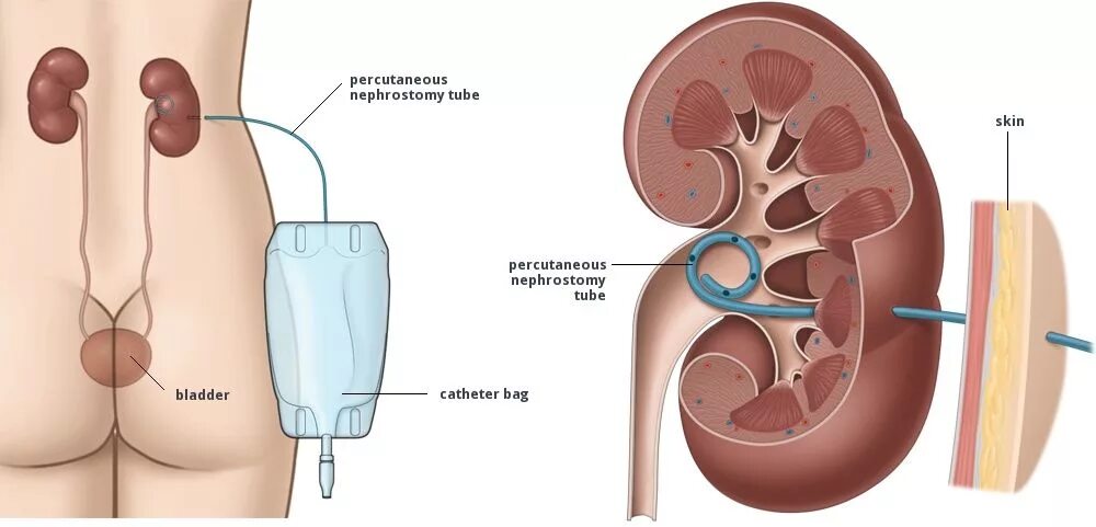 Катетер не идет моча. Нефростома – Стома почки. Дренажный катетер нефростома. Катетер стент мочеточника.