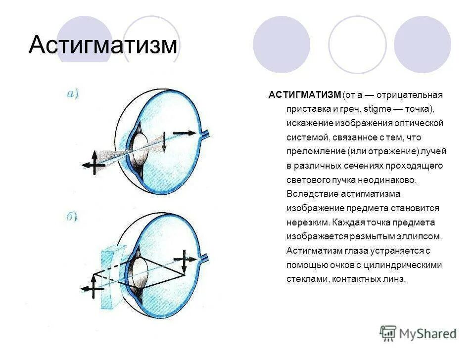 Астигматизм противопоказания. Астигматизм (виды, принципы коррекции).. сложный миопический астигматизм. дефекты зрения астигматизм. астигматизм 7 диоптрий.