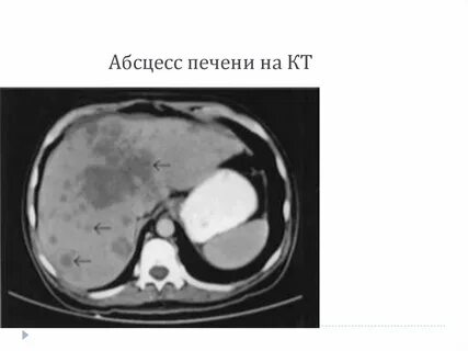 Абсцесс печени что это такое