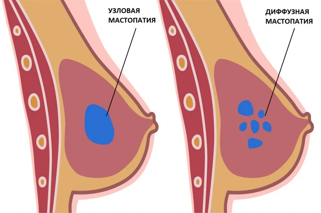 Диффузно кистозная мастопатия молочных. Узловая фиброзно-кистозная мастопатия. узловая кистозная мастопатия молочных желез. диффузная и узловая мастопатия. фиброзно кистозный мастит.