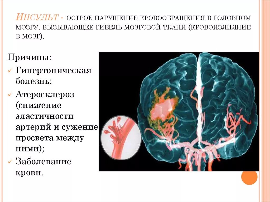 Нарушение кровообращения. Нарушение кровообращения мозга. Нарушение кровоснабжения головного мозга. Кровоизлияние в головной мозг. Острые нарушения головного кровообращения