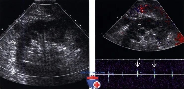 Тромбоз почечной вены УЗИ. Тромбоз почечных вен на УЗИ. Тромбоз почечной артерии. Тромбоз почечной артерии на УЗИ. Тромбоз почечной вены