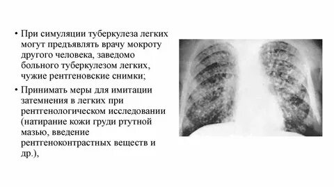 Очаговый туберкулез мокрота