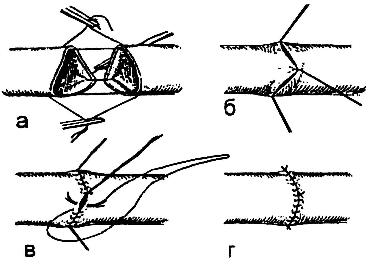 Техника наложения шва сосуда. Методика наложения сосудистого шва. Шов сосуда по Каррелю Морозовой. Как называется шов после операции
