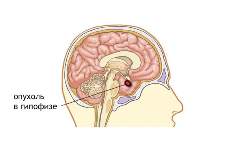 Нос и головной мозг. Опухоль аденома гипофиза. Опухоль гипофиза головного мозга. Аденома гипофиза головного мозга симптомы. Аденома гипофиза головного мозга что это такое.